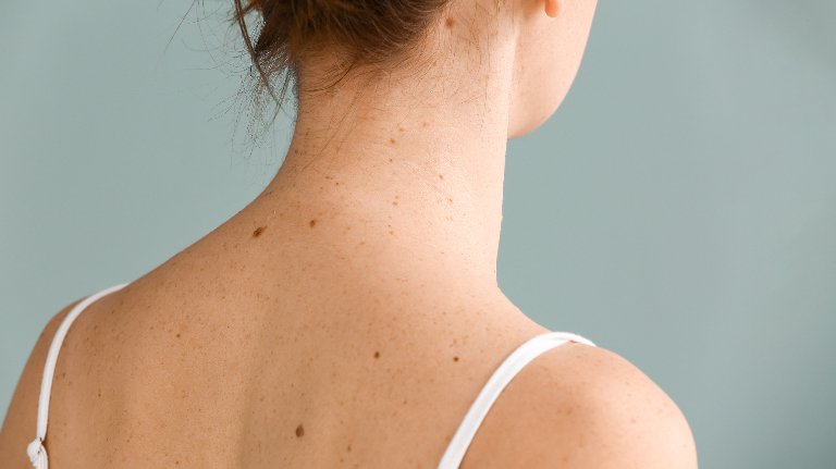 Почему появляются родинки