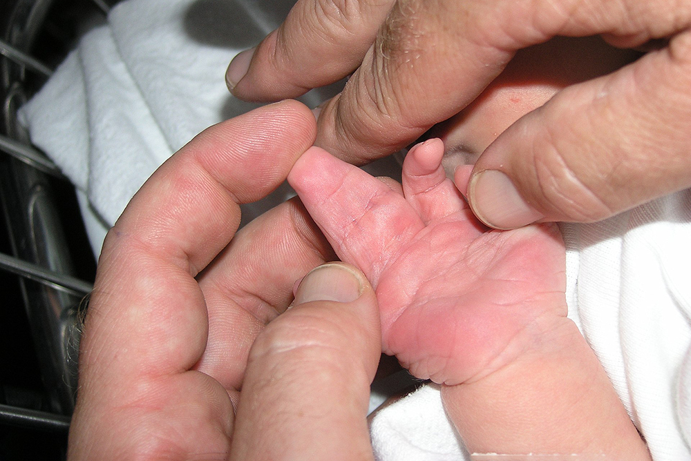 Синдактилия