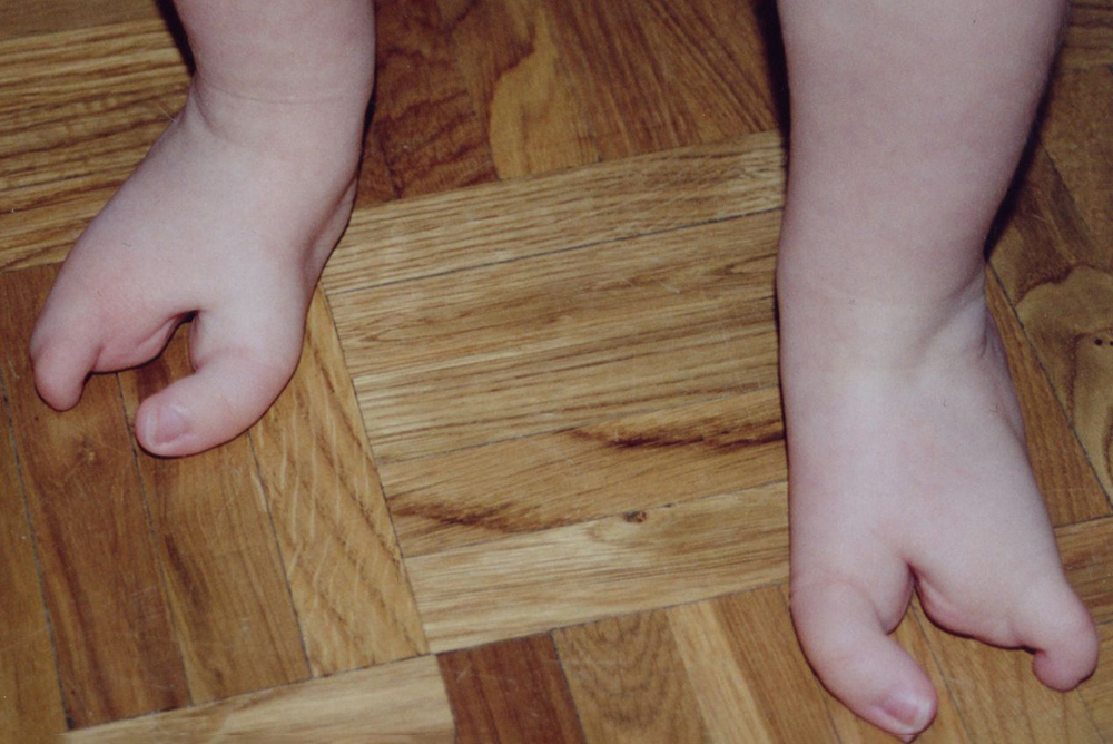 Эктродактилия