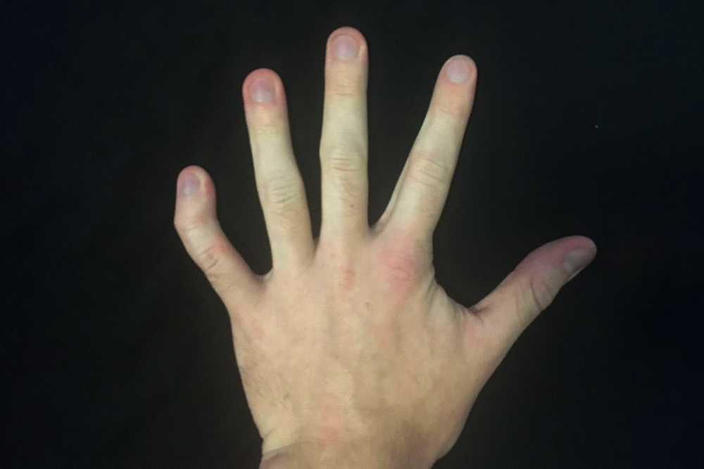 Клинодактилия