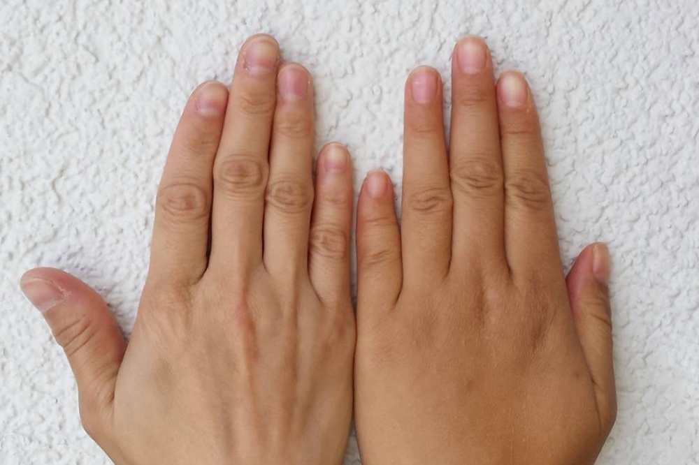 Брахидактилия